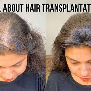 Hair Transplantation - Yay or Nay?