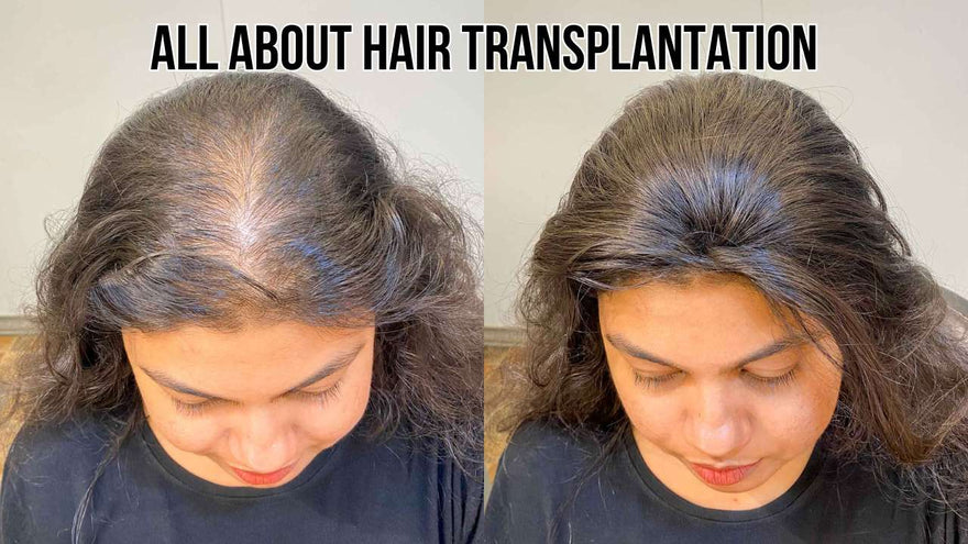 Hair Transplantation - Yay or Nay?